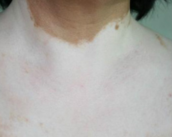 白癜风到了晚期还能治好吗 白癜风到了晚期还能治好吗